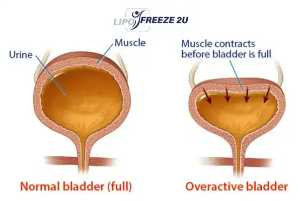 diagram of overactive bladder treatment Banbury