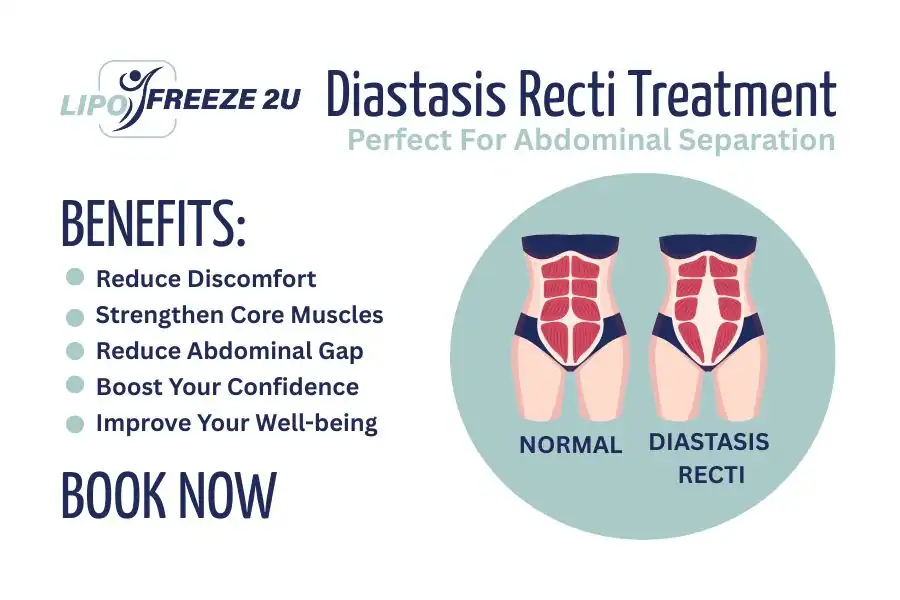How Long Will It Take to See Improvements in Diastasis Recti Banbury