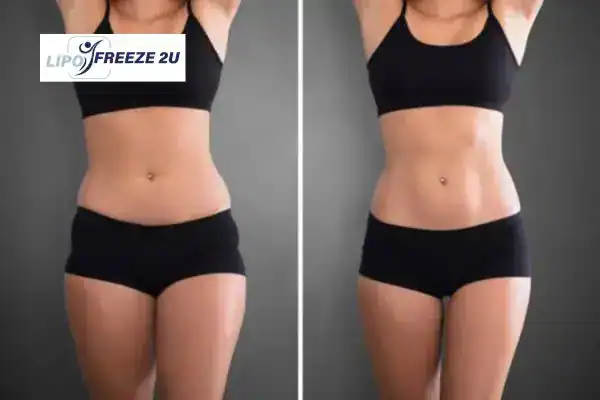 How Can LIPO FREEZE 2U Support Your Post-Pregnancy Body Recovery Banbury?