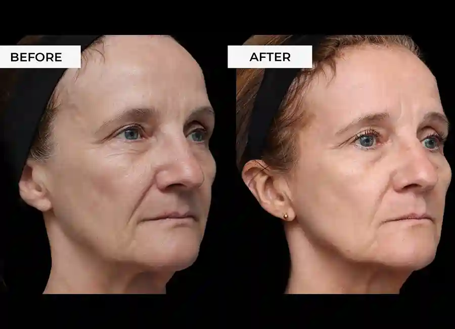 How Many RF Microneedling Sessions Will You Need to See a Difference Banbury?
