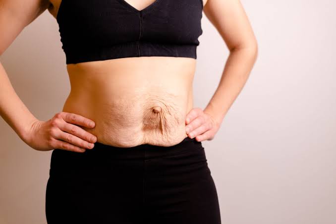 Is Surgery Really the Only Way to Repair Diastasis Recti Banbury?