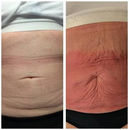 How Does RF Microneedling Improve Crepey, Thin and Uneven Skin Texture Banbury?