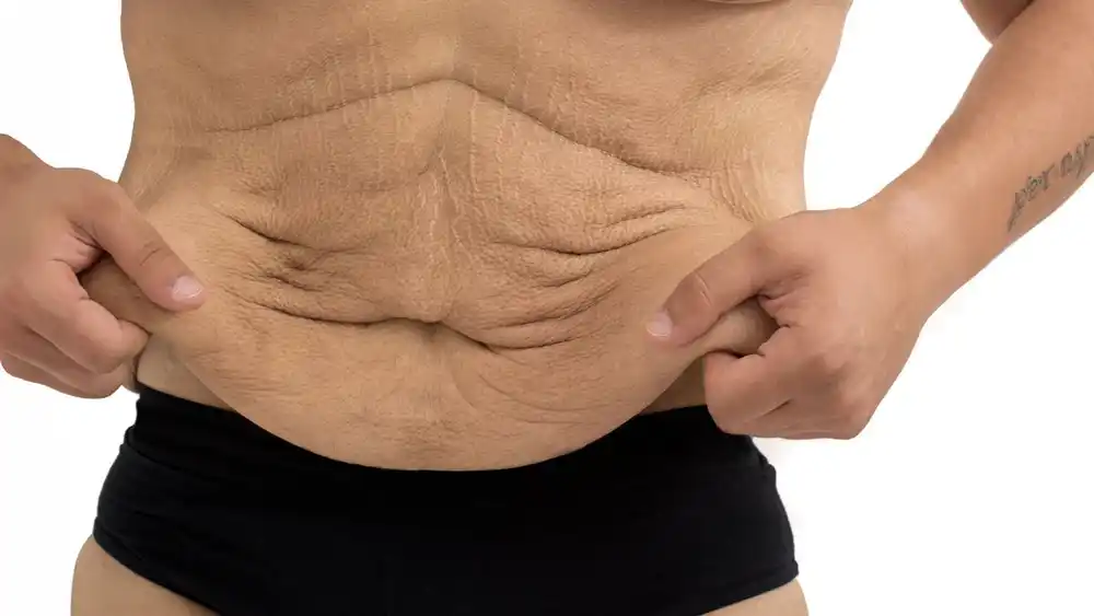 Why Does Weight Loss Medication Leave Some People With Loose or Sagging Skin Banbury?